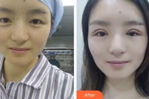 昆明超然醫(yī)學整形美容外科醫(yī)院李晉豫整形價格表附切開雙眼皮案例展示