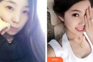 昆明麗都醫(yī)療美容醫(yī)院李榮整形價格表附牙齒隱形矯正案例展示