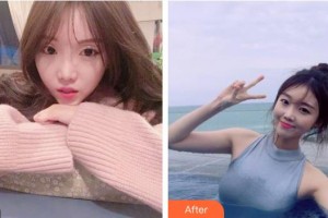 昆明都市儷人美容醫(yī)院張慶森整形價格表附去痘印痘坑案例展示