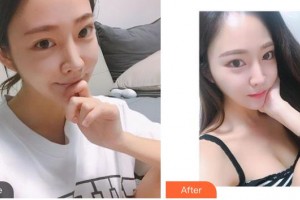 整形醫(yī)院王強(qiáng)整形價格表附光子嫩膚案例展示