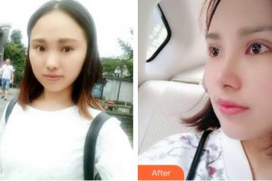 昆明天倫婦產(chǎn)醫(yī)院醫(yī)學(xué)整形美容中心李松虎整形價格表附鼻部綜合案例展示