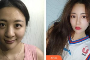 昆明吳氏嘉美美容醫(yī)院劉洋整形價格表附鼻部綜合案例展示