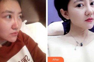 昆明吳氏嘉美美容醫(yī)院吳承道整形價格表附鼻部綜合案例展示