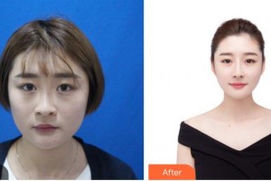 昆明吳氏嘉美美容醫(yī)院朱妮娜整形價格表附鼻修復(fù)案例展示