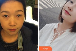 昆明同仁醫(yī)院醫(yī)療美容科楊恰佳整形價格表附假體隆鼻案例展示