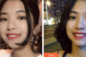 昆明前衛(wèi)美眼整形?？圃\所劉流整形價(jià)格表附牙齒隱形矯正案例展示