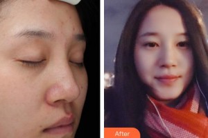 昆明都市儷人美容醫(yī)院李弘基整形價格表附祛斑祛痣案例展示