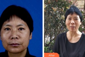 昆明市延安醫(yī)院杰西艾美容醫(yī)院謝國華整形價(jià)格表附微針美膚案例展示