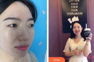 昆明維多利亞醫(yī)療美容醫(yī)院王興弘整形價(jià)格表附光子嫩膚案例展示