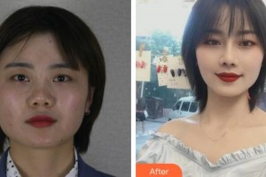 昆明同仁醫(yī)院醫(yī)療美容科劉波整形價格表附耳軟骨復合隆鼻案例展示