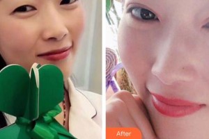 昆明韓辰整形醫(yī)院李相奇整形價格表附切開雙眼皮案例展示