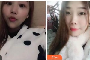 整形醫(yī)院胡靖整形價格表附自鎖托槽矯正案例展示