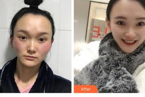 昆明維多利亞醫(yī)療美容醫(yī)院金浩彬整形價格表附顴骨顴弓整形術(shù)案例展示