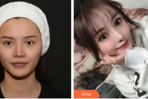 昆明都市儷人美容醫(yī)院蔡瑞整形價格表附假體墊眉弓案例展示