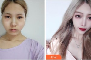 昆明卓星美容醫(yī)院牛軍州整形價格表附顴骨降低案例展示