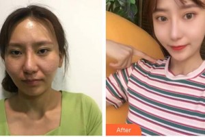 昆明愛萊美醫(yī)療美容醫(yī)院徐和林整形價格表附顴骨顴弓整形術(shù)案例展示