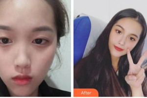 整形醫(yī)院唐俊整形價格表附鼻部綜合案例展示