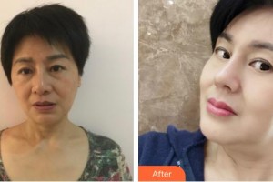 昆明美吉星醫(yī)療美容門診部陸磊整形價格表附膨體隆鼻案例展示