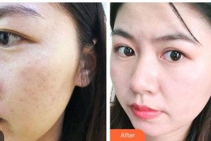 昆明韓辰整形醫(yī)院李杰整形價格表附微針美膚案例展示