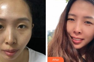 昆明夢想醫(yī)療美容醫(yī)院黎洪棉整形價格表附去痘印痘坑案例展示