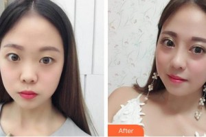 昆明同仁醫(yī)院醫(yī)療美容科鐘青杰整形價格表附鼻部綜合案例展示