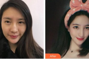 昆明夢想醫(yī)療美容醫(yī)院趙正杰整形價格表附膨體隆鼻案例展示