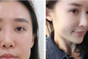 昆明薇莎整形美容醫(yī)院樸炫中整形價格表附假體隆鼻案例展示