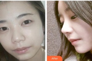 昆明都市儷人美容醫(yī)院孫燕整形價格表附鼻部綜合案例展示