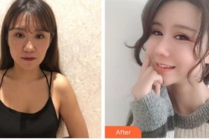 昆明薇莎整形美容醫(yī)院梁啟春整形價格表附肋軟骨隆鼻案例展示