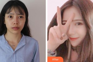 昆明美立方（原大華）醫(yī)療美容醫(yī)院李勁良整形價(jià)格表附鼻部綜合案例展示