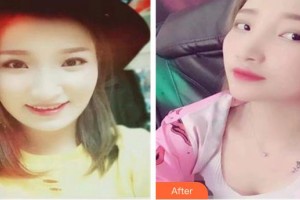 昆明美立方（原大華）醫(yī)療美容醫(yī)院鄭華山整形價格表附玻尿酸精華導(dǎo)入案例展示