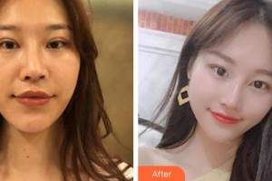 昆明夢(mèng)想醫(yī)療美容醫(yī)院祝勇整形價(jià)格表附激光祛斑案例展示