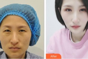 昆明美伊萊醫(yī)療美容門診部陳玉瓊整形價(jià)格表附眼部修復(fù)例展示