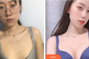 昆明夢想醫(yī)療美容醫(yī)院童列健整形價格表附自體脂肪隆胸案例展示