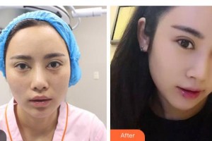 昆明市第一人民醫(yī)院星耀醫(yī)院杜海寬整形價(jià)格表附切開雙眼皮案例展示