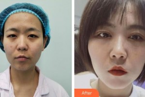 昆明前衛(wèi)美眼整形?？圃\所夏玲整形價(jià)格表附眼部綜合案例展示