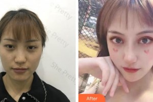 昆明前衛(wèi)美眼整形專科診所吳瓊整形價(jià)格表附切開雙眼皮案例展示