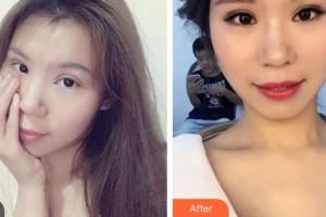 昆明市第一人民醫(yī)院星耀醫(yī)院合美紅整形價格表附切開雙眼皮案例展示