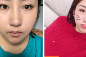 昆明美立方（原大華）醫(yī)療美容醫(yī)院晉超整形價(jià)格表附切開雙眼皮案例展示