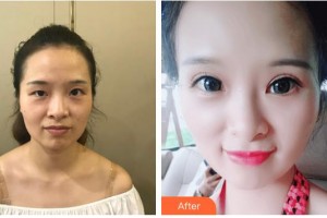 昆明璽蘭醫(yī)療美容診所趙建凱整形價格表附眼部案例展示