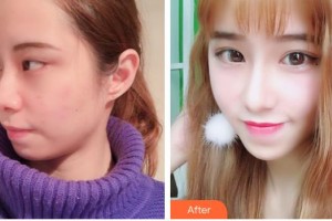 昆明璽蘭醫(yī)療美容診所劉斌整形價格表附眼部綜合案例展示