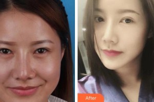 昆明同仁醫(yī)院醫(yī)療美容科劉景楨整形價格表附眼部綜合案例展示