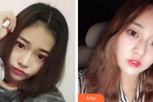 昆明同仁醫(yī)院醫(yī)療美容科李淵整形價格表附眼部修復案例展示