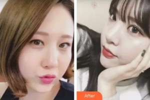 昆明璽蘭醫(yī)療美容診所王卓整形價格表附開外眼角案例展示