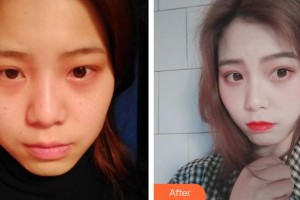 清遠康華醫(yī)院整形美容中心（原清遠武警醫(yī)院整形美容中心）徐昆明住院醫(yī)師整形價格表附激光祛斑案例展示