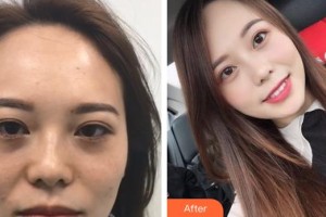 昆明華山眼科醫(yī)院夏歆昱整形價格表附內切祛眼袋案例展示