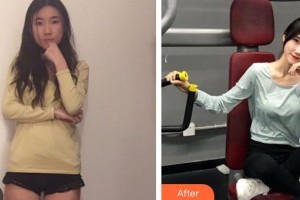 昆明海峽整形美容醫(yī)院趙根云整形價格表附玻尿酸精華導入案例展示