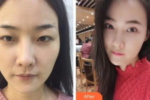 昆明華山眼科醫(yī)院肖云皋整形價格表附眼部綜合案例展示