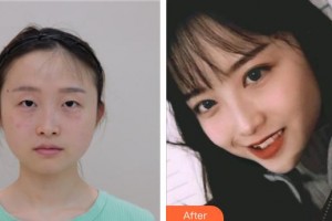 昆明醫(yī)科大學第二附屬醫(yī)院整形外科肖敏勤整形價格表附切開雙眼皮案例展示