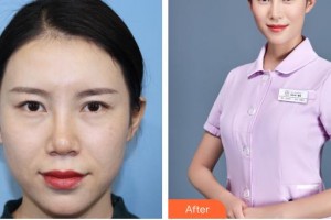 昆明華山眼科醫(yī)院李旭松整形價格表附內切祛眼袋案例展示